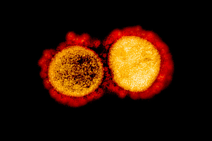 Betegtől izolált SARS-CoV-2 vírusrészecskék transzmissziós elektronmikroszkópiája -Fotó: NIH / NIAID / BSIP / Getty Images