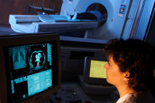 Egy brit kutatás szerint a tüdődaganatok 70 százaléka már korai stádiumban kimutatható lenne CT-vizsgálattal