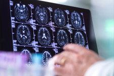 Engedélyeztek egy új Alzheimer-gyógyszert az USA-ban, pedig sok szakértő nem bízik a hatásosságában