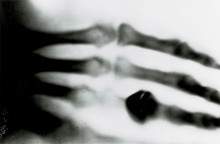 Roentgen első felvétele felesége kezéről 1895-ből – Forrás: SSPL / Getty Images