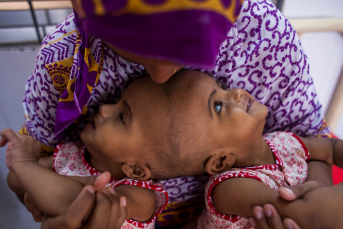 Két évvel a szétválasztásuk után az otthonukban ünnepelhették a születésnapjukat a bangladesi ikrek