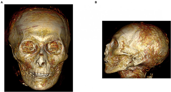 I. Amenhotep számítógépes tomográfiával feltárt koponyája. Forrás: Frontiers in Medicine