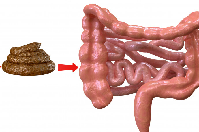 Kész a gyógyszer, ami feleslegessé teheti a székletbeültetéseket