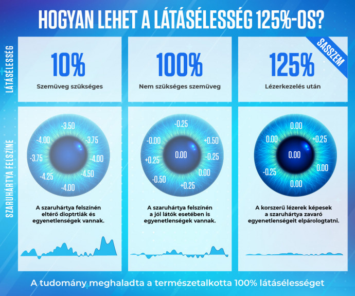 A Sasszemkezeléssel tökéletesebbre korrigálhatja a lézer a szaruhártya felszínét, így érhető elő a 100% feletti látás – Forrás: Sasszemklinika