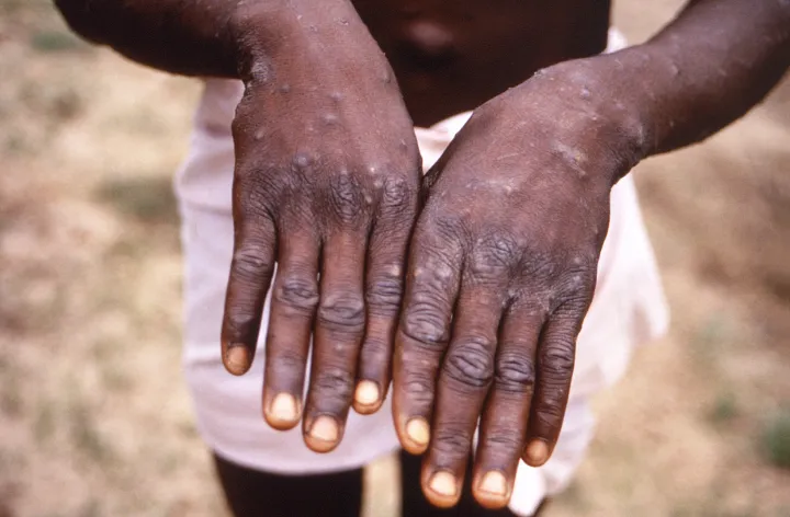 A vírus által okozott elváltozások egy beteg kezén Kongóban 1997-ben – Fotó: Smith Collection / gado / Getty Image
