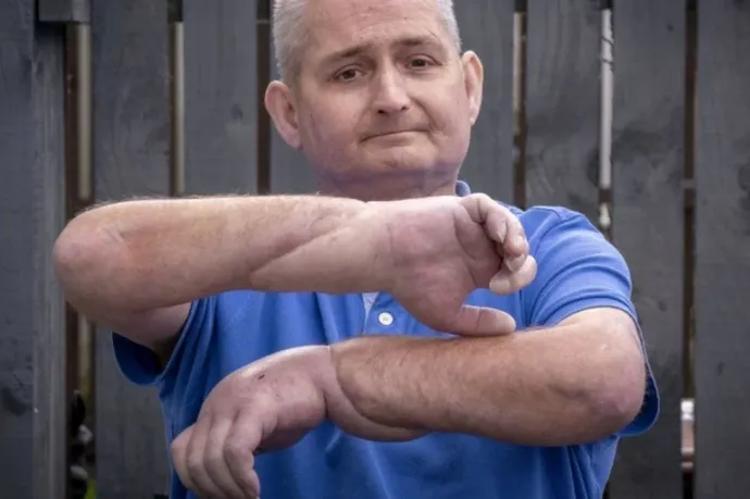 Sikeresen hajtottak végre dupla kézátültetést az Egyesült Királyságban