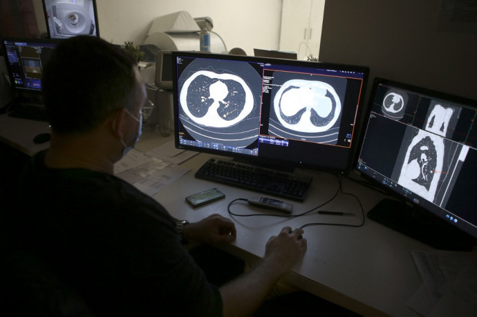 Életeket ment és pénzt spórol a jól tervezett tüdőrákszűrési program