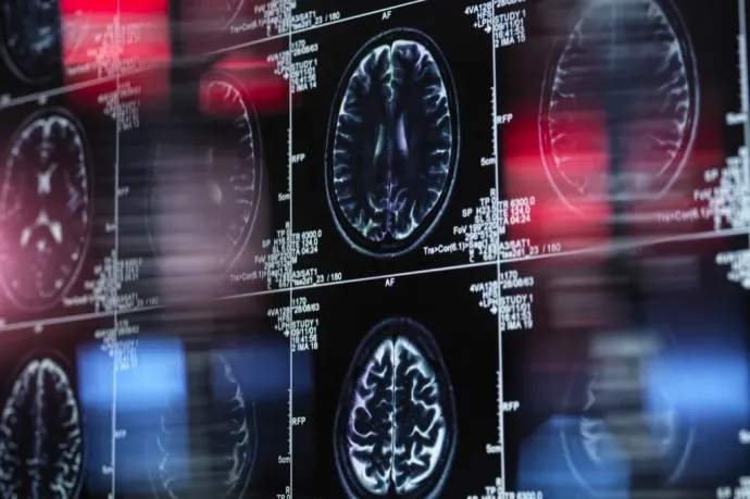 16 év Alzheimer-kutatása mehet a kukába?