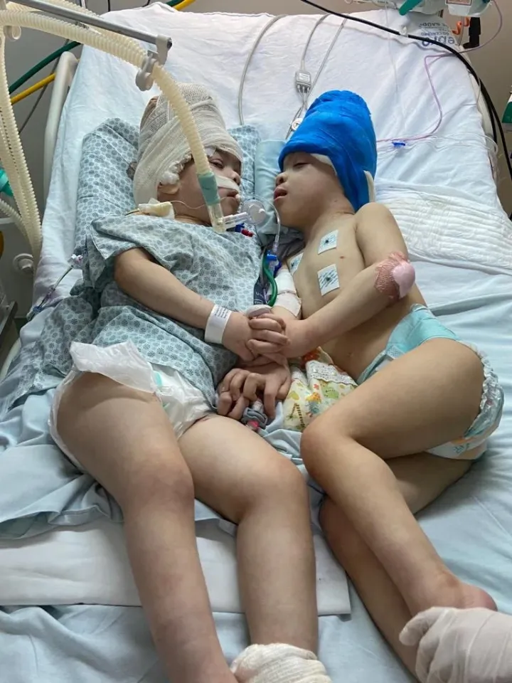 Az ikrek a szétválasztóműtét után – Fotó: Gemini Untwined & Instituto Esta / Reuters