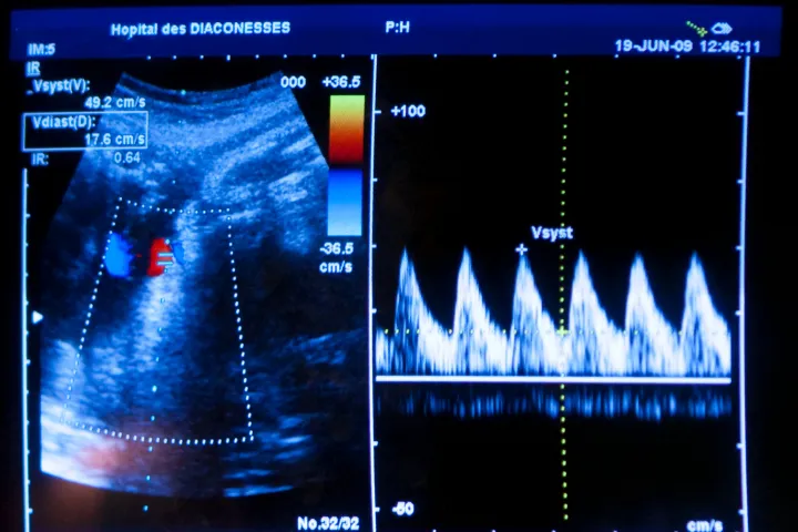 Tényleg a magzati szívhang meghallgatására kényszerítik a terhességmegszakítást kérő nőket?