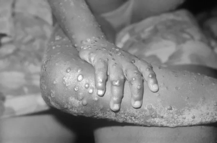 Majomhimlő okozta kiütések egy libériai kislány testén 1971-ben – Fotó: Cdc's Public Health Image Library