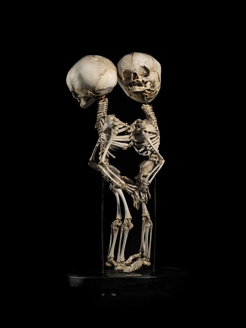 Mellkasukon összenőtt sziámi ikrek csontváza. Készítette Dr. Lenhossék József az 1844/45-ös tanévben. A második képen szkoliotikus gerincferdülést bemutató csigolyaoszlop. A betegség többek között a mellkas és a hasüreg deformálódásával és a testmagasság csökkenésével jár együtt