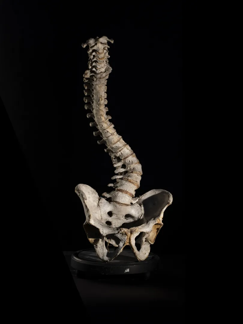 Mellkasukon összenőtt sziámi ikrek csontváza. Készítette Dr. Lenhossék József az 1844/45-ös tanévben. A második képen szkoliotikus gerincferdülést bemutató csigolyaoszlop. A betegség többek között a mellkas és a hasüreg deformálódásával és a testmagasság csökkenésével jár együtt