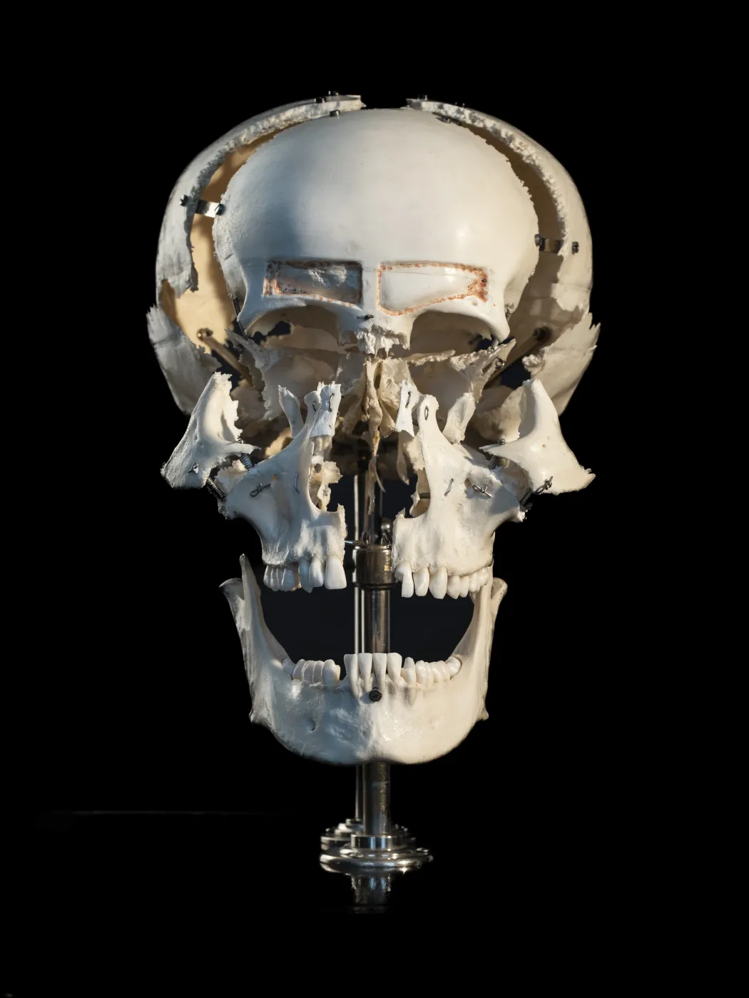 „Robbantott” koponya (másként francia koponya) a koponyát alkotó csontok bemutatására. A csontokat összetartó úgynevezett varratokat speciális eljárással feloldották