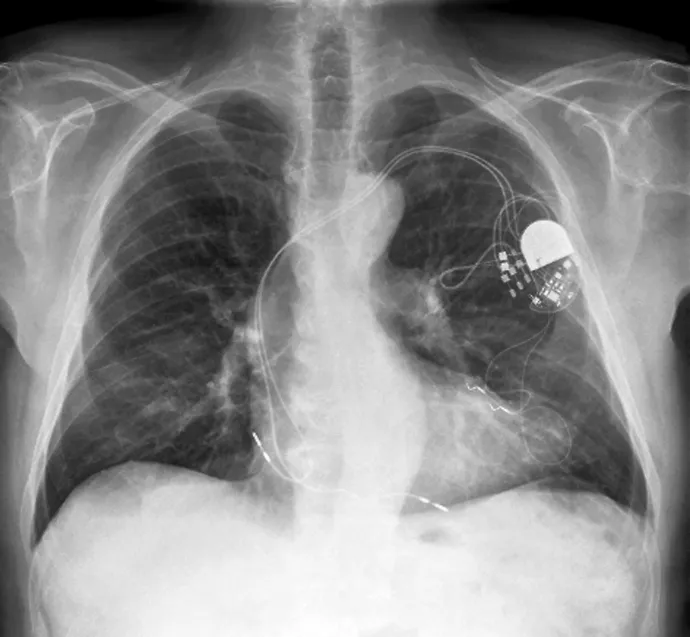 Röntgenkép egy beültetett pacemakerről – Fotó: Zephyr / Science Photo Library / AFP
