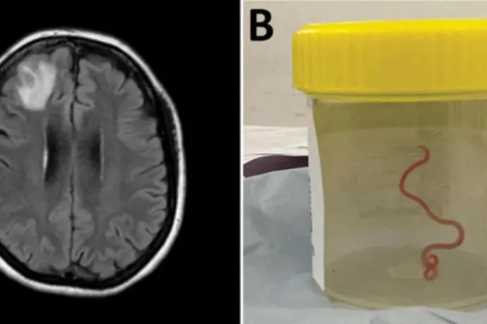 Istenem, nem hiszem el, mit találtam a fejében: él és vonaglik!