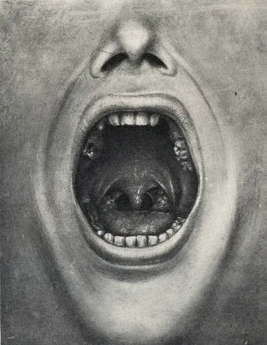 Egy eltávolított fogú száj illusztrációja Cotton a mentális betegségek és fokális fertőzések összefüggéséről írt könyvéből – Forrás: Wikipedia