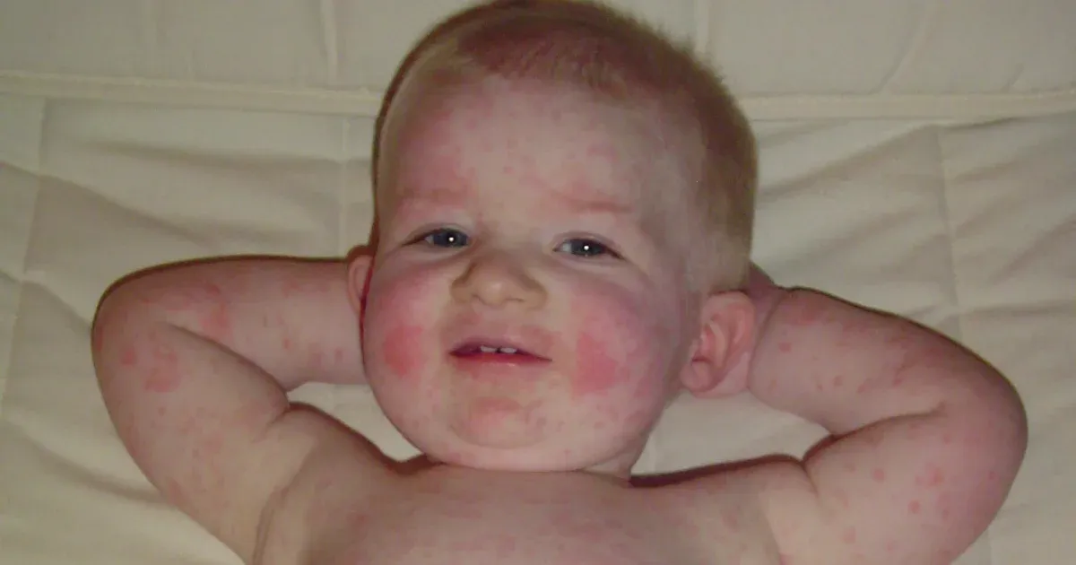 Chicken pox is spreading among kindergarteners