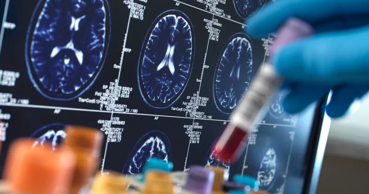 10-15 évvel a tünetek megjelenése előtt kimutatható az Alzheimer-kór egy magyar kombinált teszttel