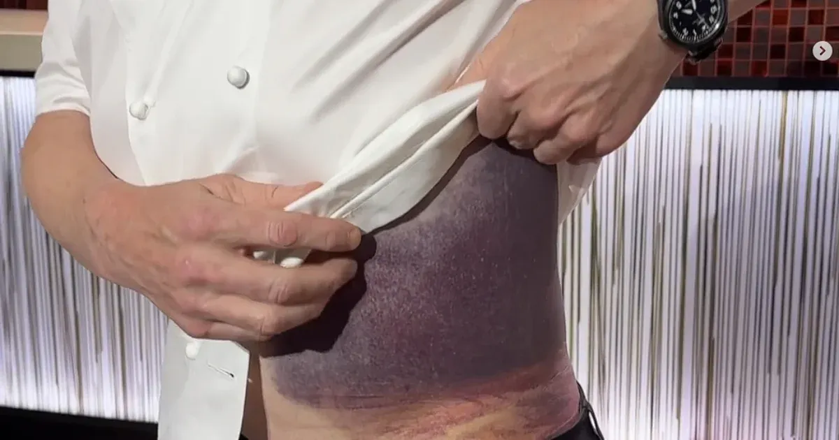 Gigantikus véraláfutást villantott a bringával eleső Gordon Ramsay
