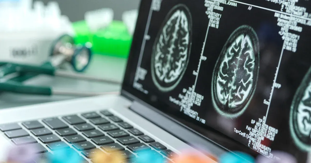 Olyan gyógyszert engedélyezett az FDA, ami lassítja az Alzheimer-kór lefolyását