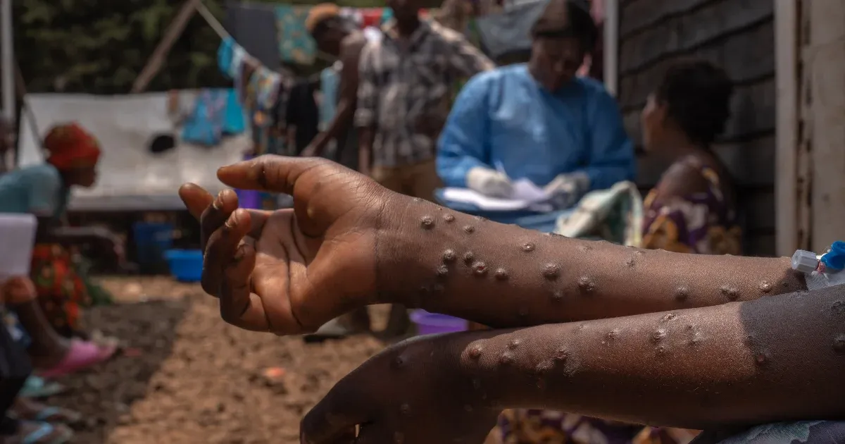 Monkeypox has not been contained in Africa.