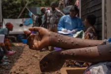 Nem sikerült megfékezni Afrikában a majomhimlőt