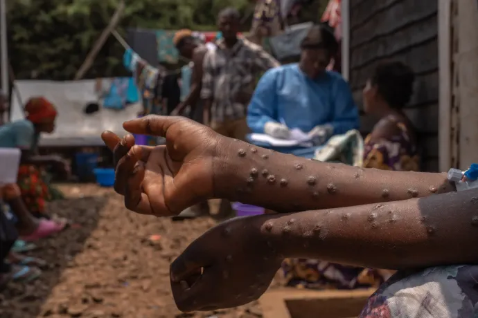 Nem sikerült megfékezni Afrikában a majomhimlőt