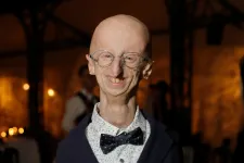 28 éves korában meghalt a progeria legidősebb ismert túlélője, Sammy Basso