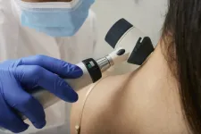Az UV-sugárzás okozza a melanómás megbetegedések több mint 80 százalékát világszerte, mondja a Nemzetközi Rákkutató Ügynökség