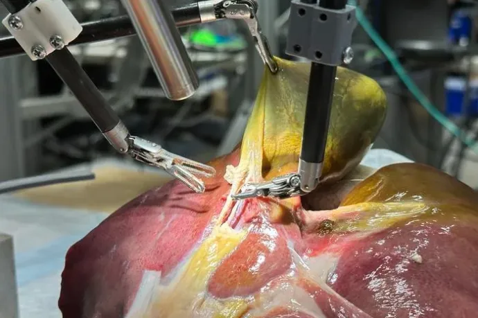 Emberi segítség nélkül, százszázalékos hatékonysággal műt epehólyagokat egy MI-alapú robotsebész