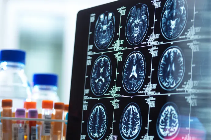 A lítium lehet a válasz az Alzheimer-kórra