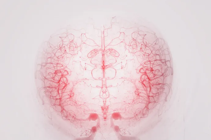 Akár öt évet is öregíthette a koronavírus-fertőzés a nők ereit