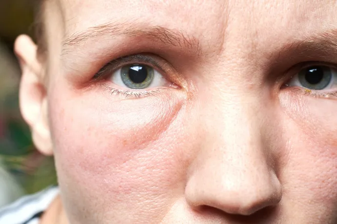 Az új netes mumus: az influenszerek szerint minden bajunk oka a kortizol