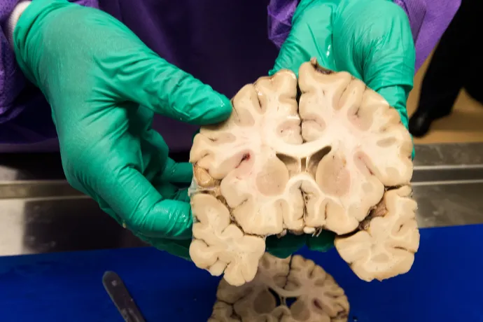 Hajléktalanoknál is gyakori az az agyi elváltozás, ami az amerikai futballistáknál