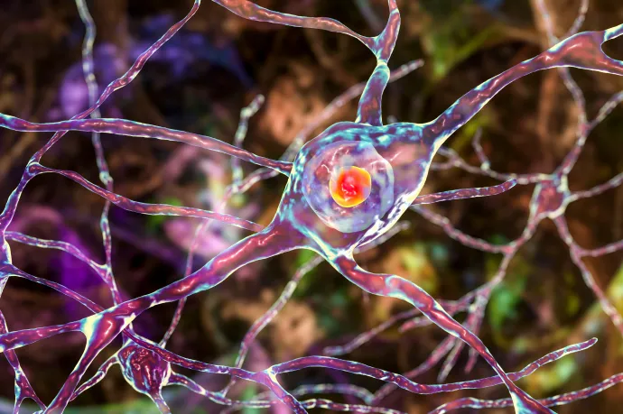 Először kezelték sikeresen génterápiával a Huntington-kórt