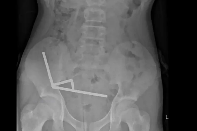 Száz darab erős mágnest rendelt a Temuról, hogy lenyelhesse őket, meg kellett műteni a 13 éves új-zélandi fiút