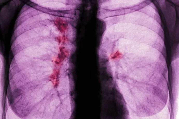A tüdőrák egy aljas, sunyi betegség, és nincs rá állami szűrőprogramunk sem