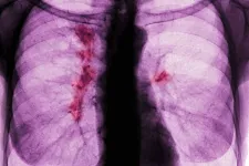 A tüdőrák egy aljas, sunyi betegség, és nincs rá állami szűrőprogramunk sem