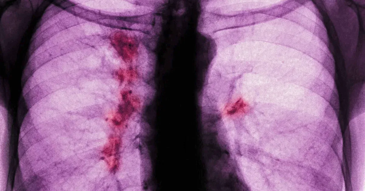 A tüdőrák egy aljas, sunyi betegség, és nincs rá állami szűrőprogramunk sem