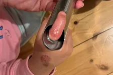 Úgy beszorult egy gyerek ujja a serpenyő nyelébe, hogy még mentőt is kellett hozzá hívni