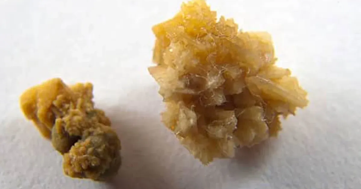 Drágakövek helyett csak a tulaj veseköveit zsákmányolták az olasz betörők