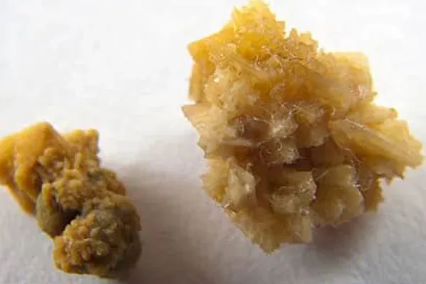 Drágakövek helyett csak a tulaj veseköveit zsákmányolták az olasz betörők