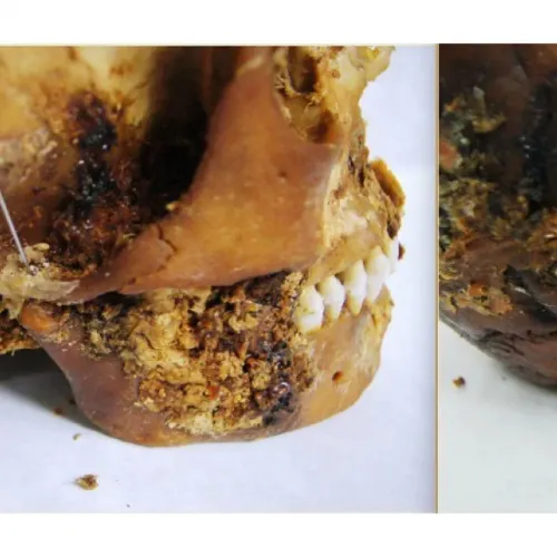 Állkapocsprotézist találtak az orosz régészek egy 2500 éve meghalt szibériai nő koponyájában