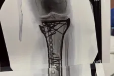 Lindsey Vonn kiposztolta, mennyi csavar és lemez kerül a sípcsontjába