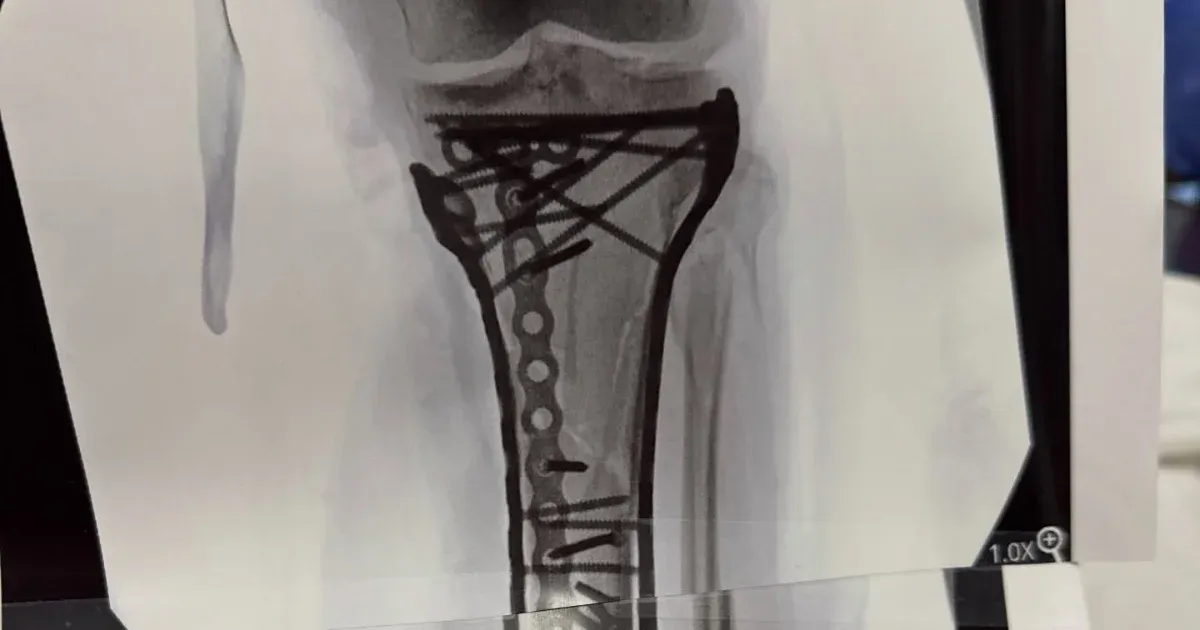Lindsey Vonn kiposztolta, mennyi csavar és lemez kerül a sípcsontjába