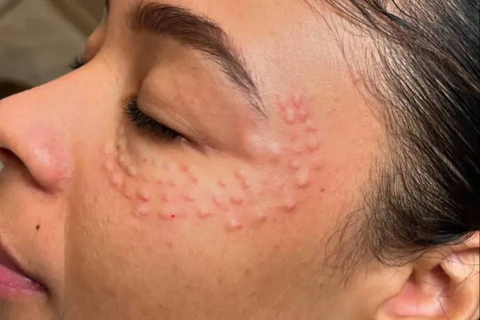 A botox helyett a lazacsperma az új bőrfiatalító őrület