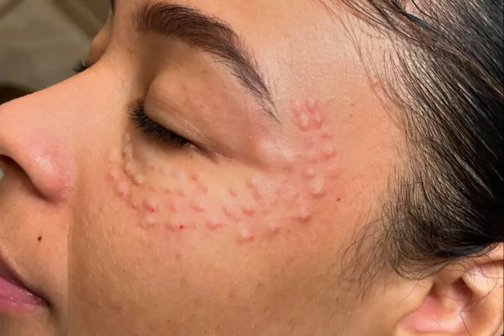 A botox helyett a lazacsperma az új bőrfiatalító őrület