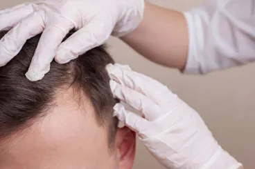 Klinikai hajkezelés otthon: a szérumhoz orvosi stáb jár egy hónapig (x)