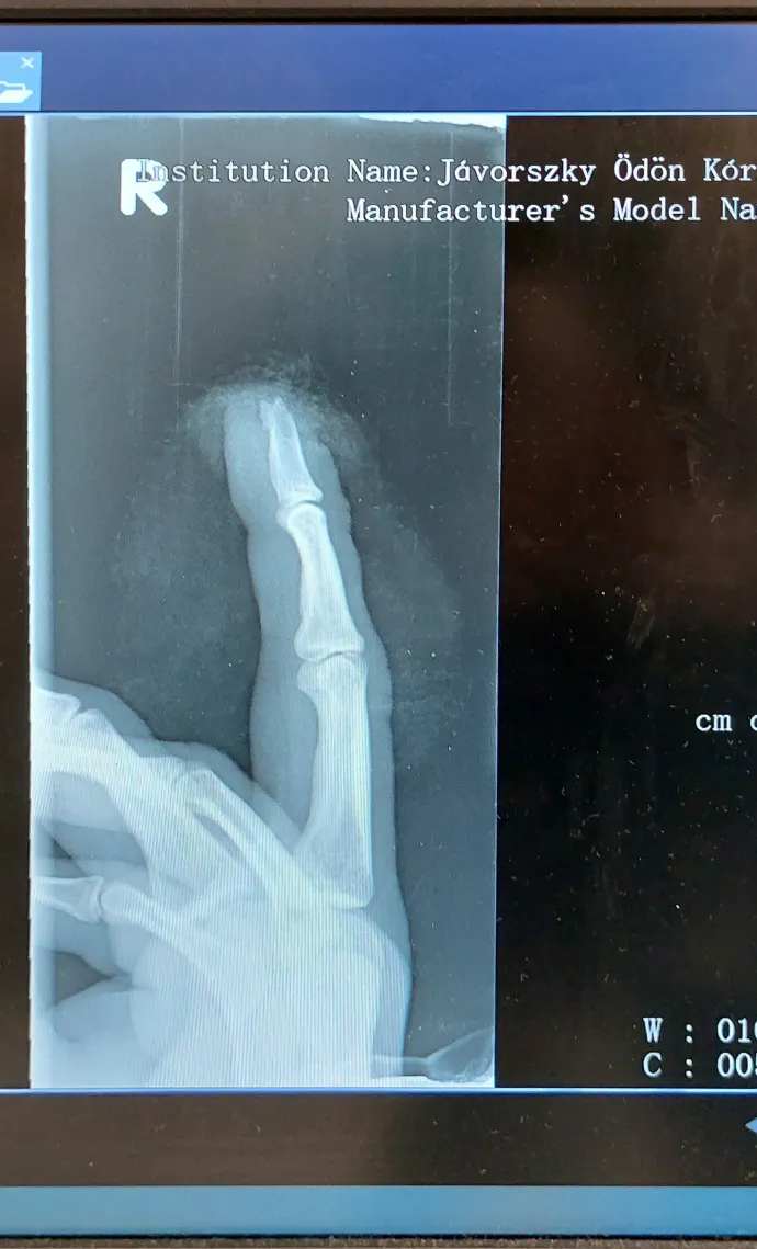 Ádám sérült ujjának röntgenképe a Váci Jávorszky Ödön Kórházban